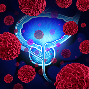 Personalizing Prostate Cancer Treatment