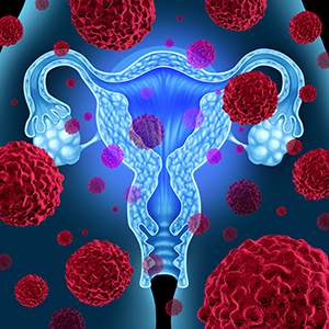 Uterine Cancer Rates on the Rise