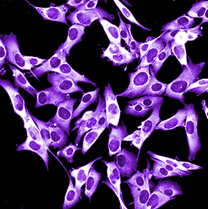 Melanoma Risk Increased in Some Lymphoma Survivors