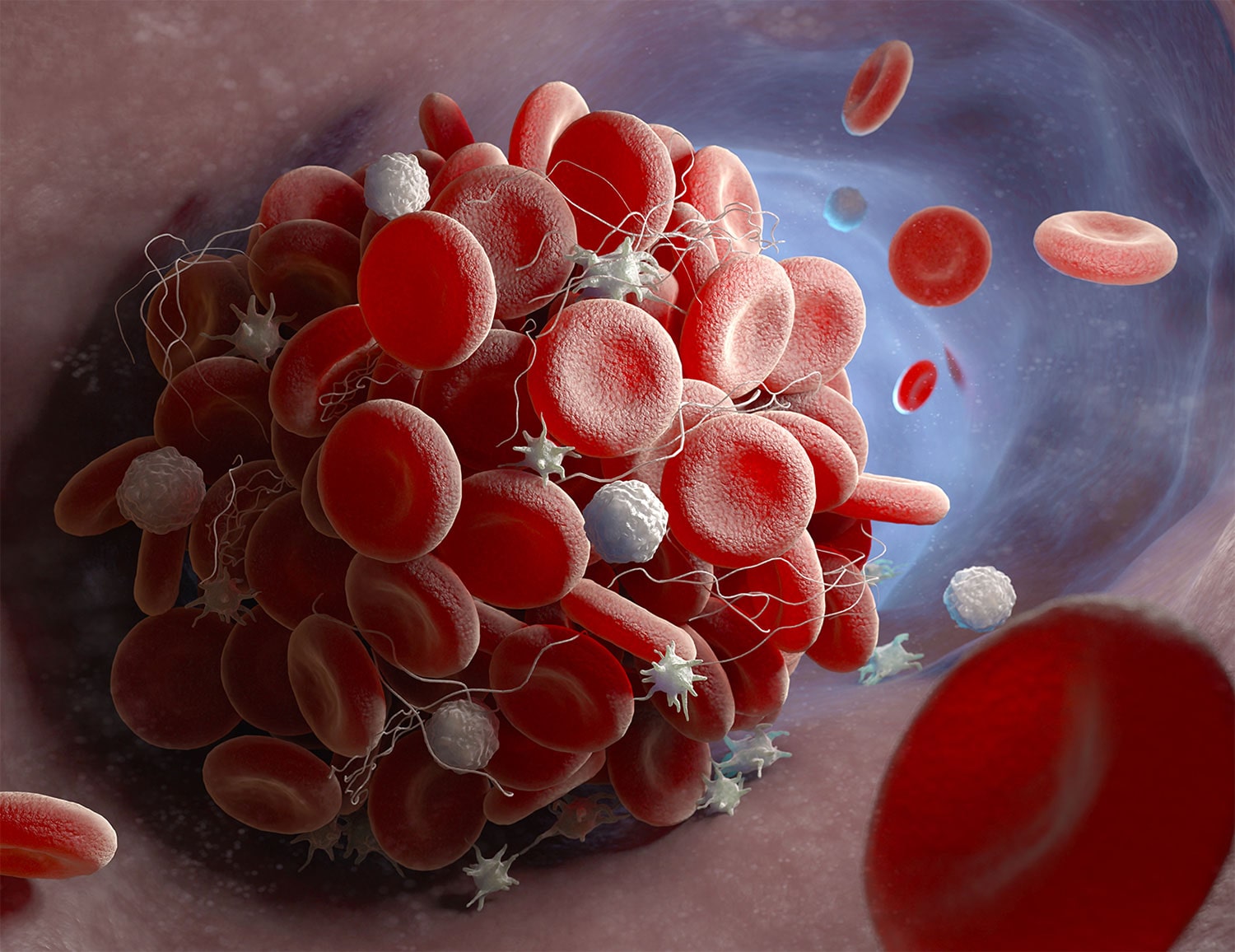 More Options to Prevent Blood Clots in High-Risk Cancer Patients