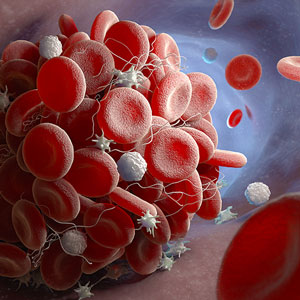 More Options to Prevent Blood Clots in High-Risk Cancer Patients