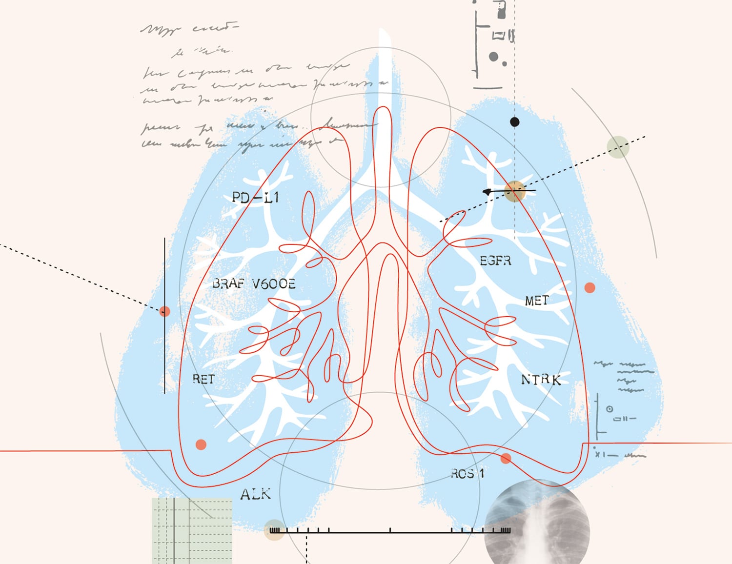 More Choices to Treat Lung Cancer