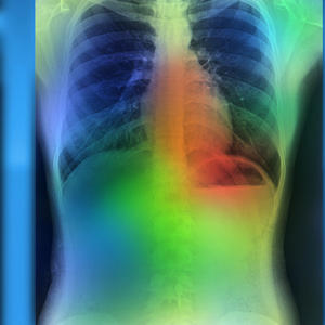 New Therapies for Metastatic Lung Cancer