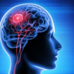 Treating Brain Metastases