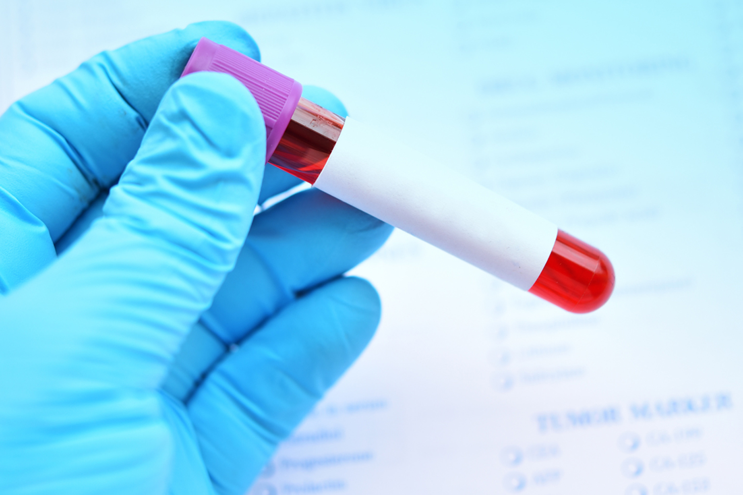 Blood Test Could Predict Cancer Recurrence and Treatment Side Effects