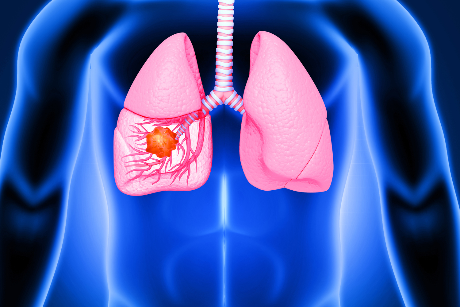 Choosing Between Lung Cancer Surgery and Radiation