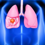 Choosing Between Lung Cancer Surgery and Radiation