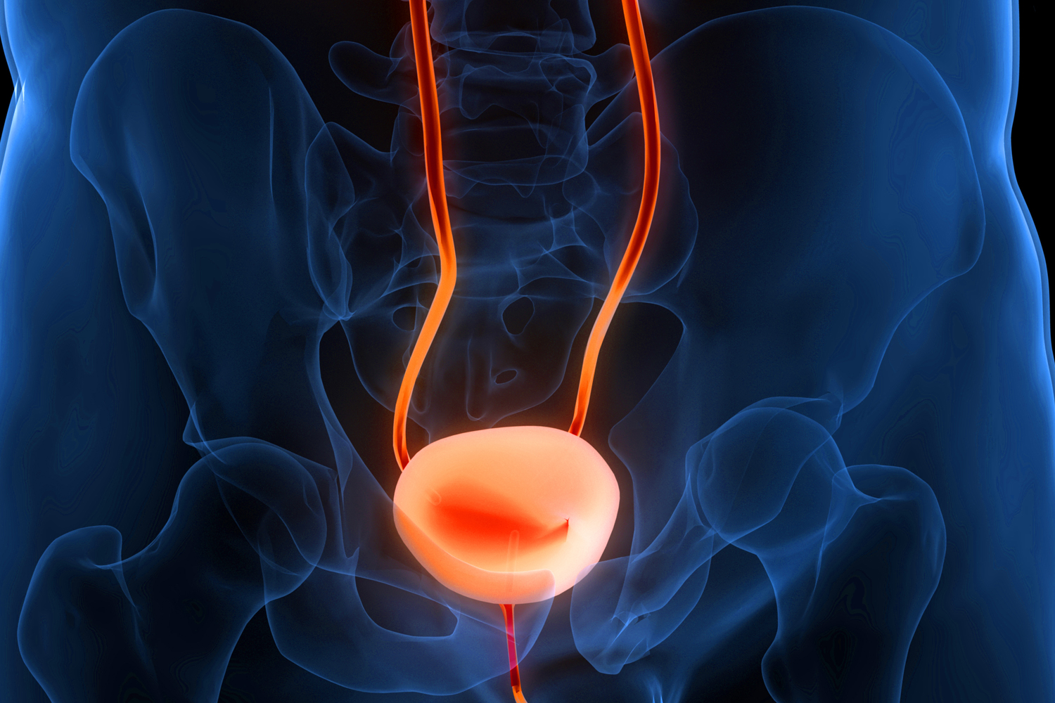 New Chemotherapy Delivery Device in Bladder Cancer