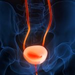 New Chemotherapy Delivery Device in Bladder Cancer
