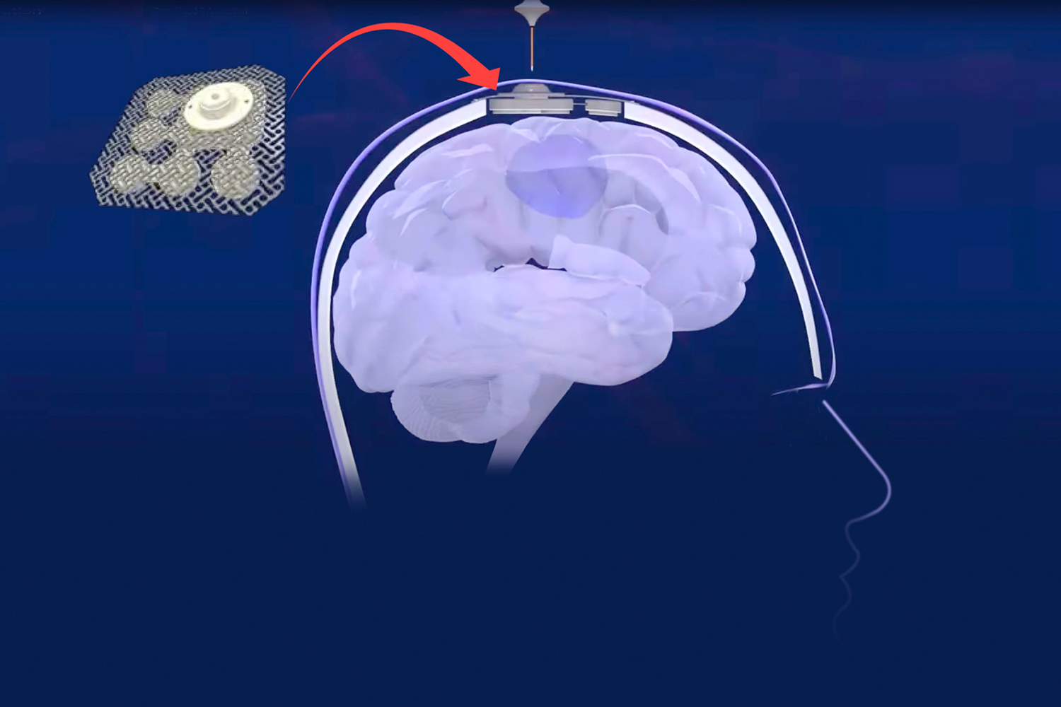 Ultrasound Device Opens Blood-brain Barrier