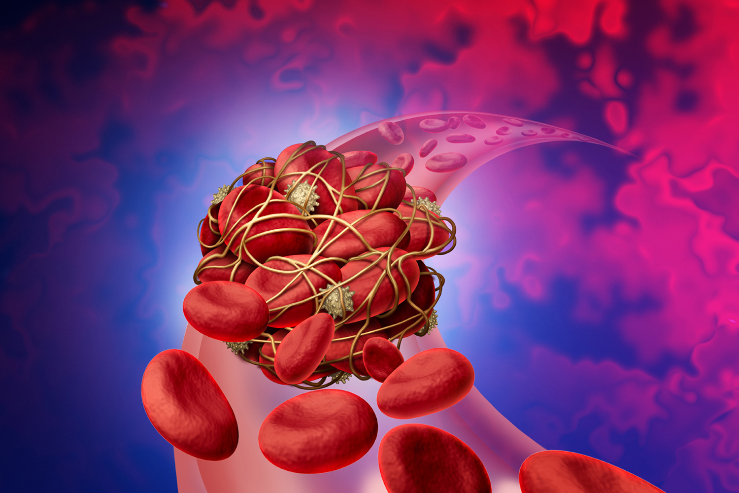 Preventing Blood Clots
