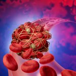 Preventing Blood Clots