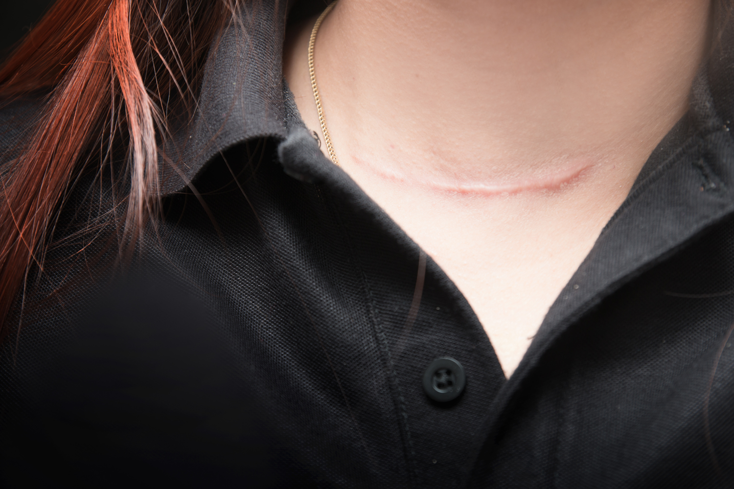 How can I address scars from cancer surgery?