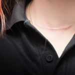 How can I address scars from cancer surgery?