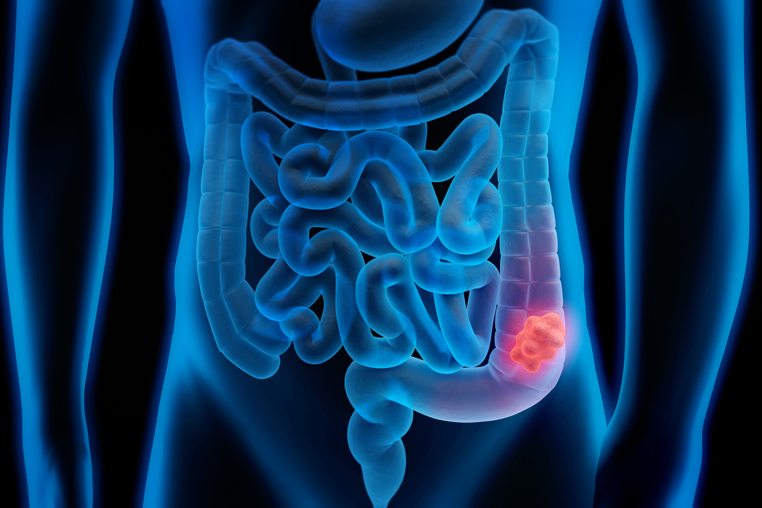 Improving Colorectal Cancer Screening Options