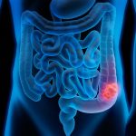 Improving Colorectal Cancer Screening Options