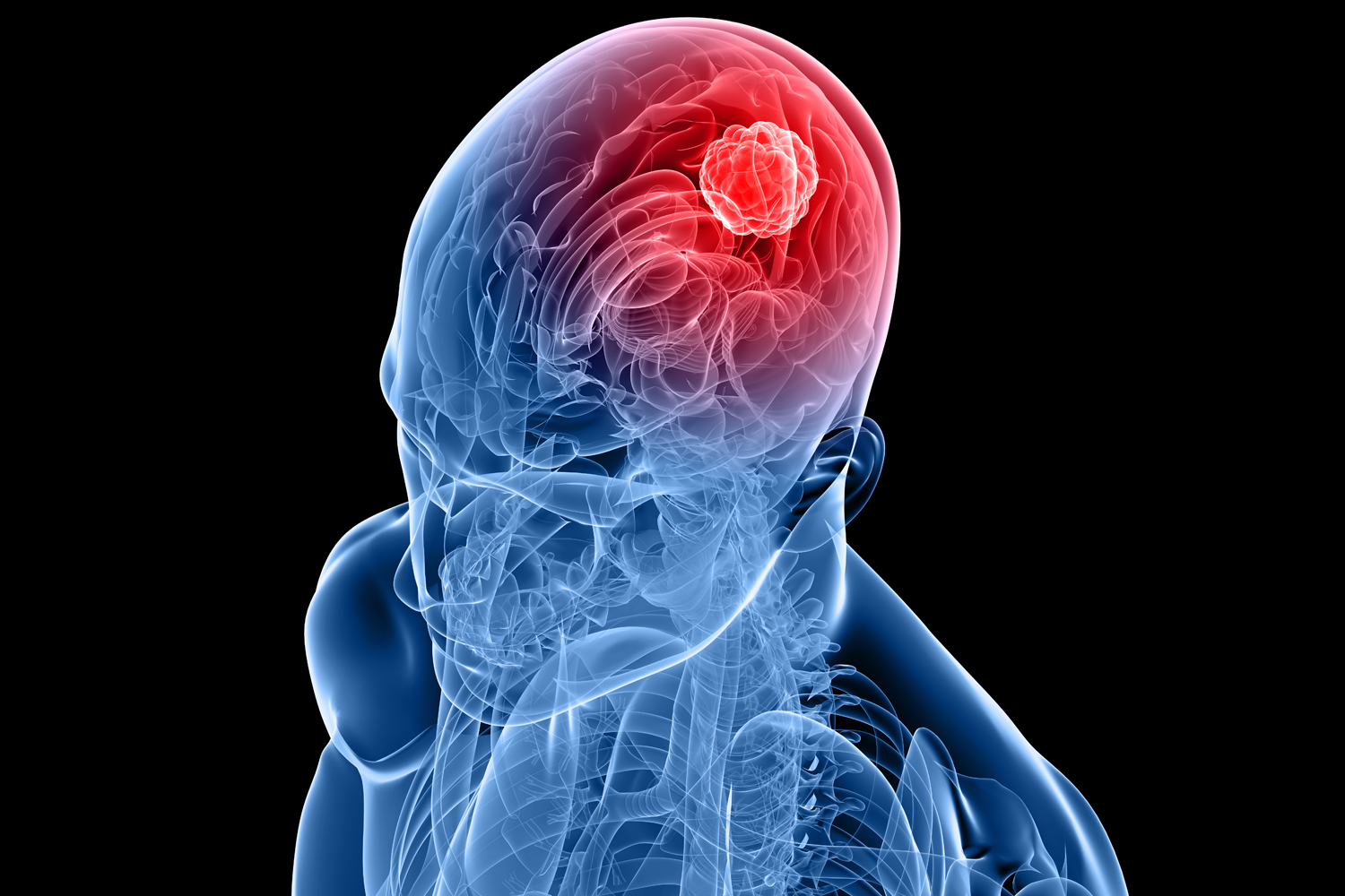 Improving Glioblastoma Treatment