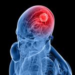 Improving Glioblastoma Treatment