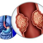 Expanding Options in Esophageal Cancer