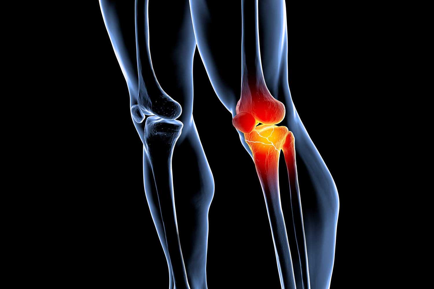 Can cancer treatment damage my bones?