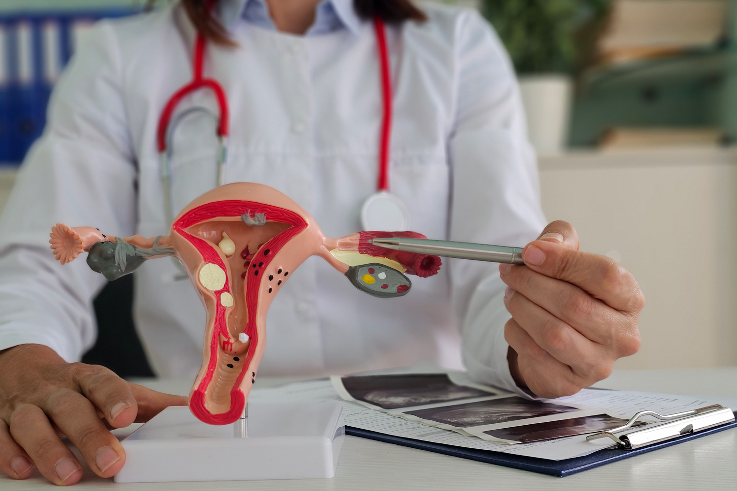 Reducing Ovarian Cancer Risk
