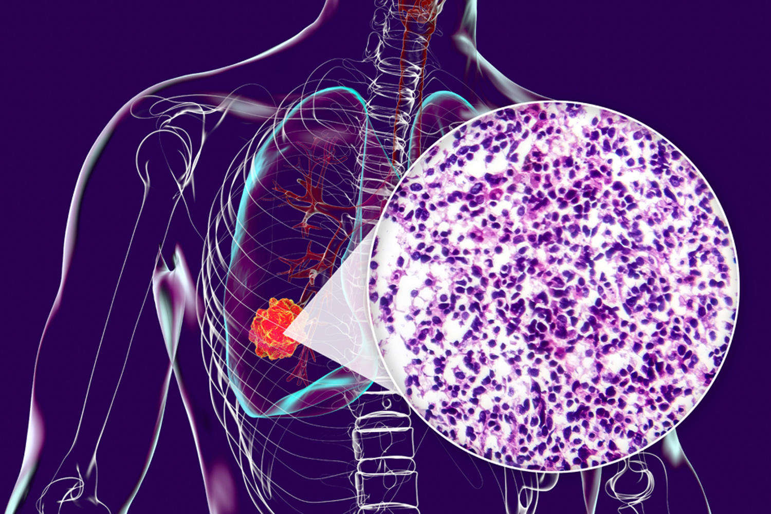 A Combination Approach for EGFR-positive Lung Cancer