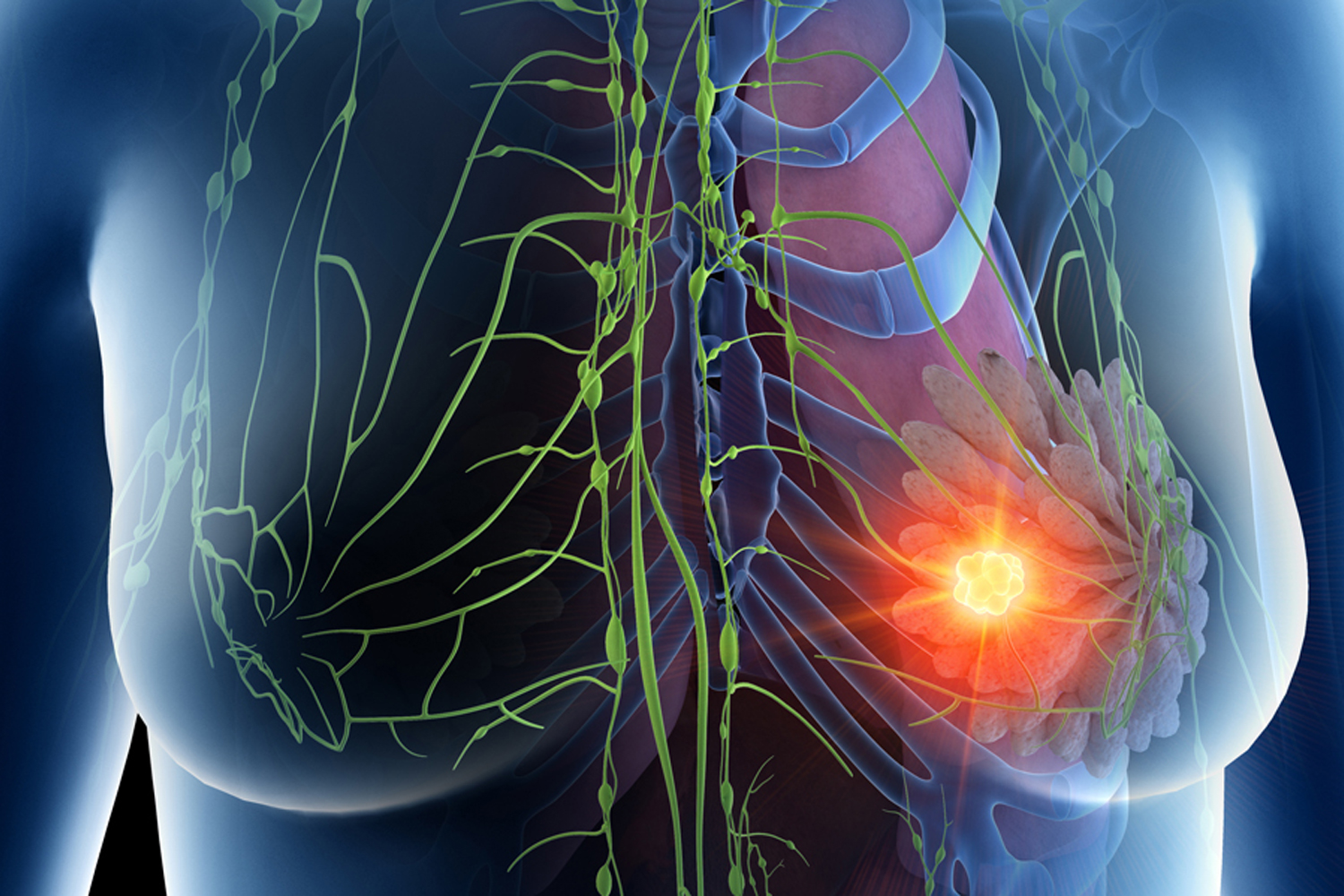 Improving Breast Cancer Outcomes After Surgery