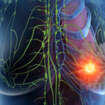 Improving Breast Cancer Outcomes After Surgery