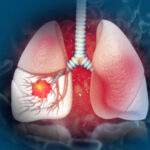 September 12: The Week in Cancer News