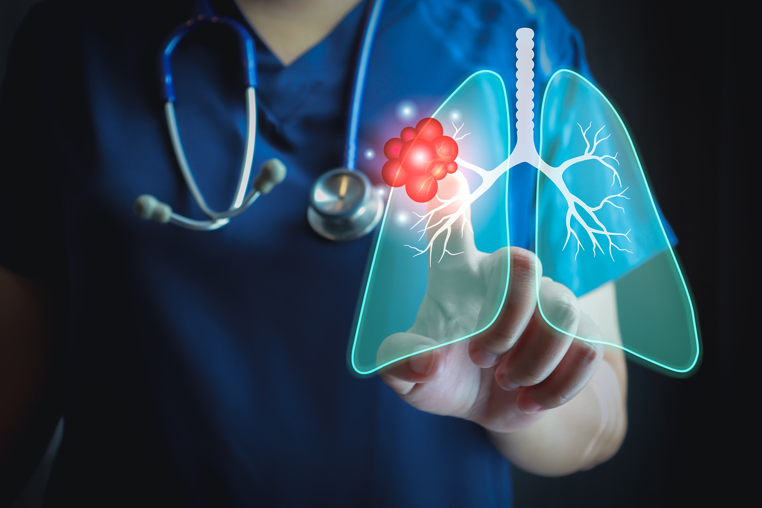 Treatment Combination Improves Survival in EGFR-positive Lung Cancer