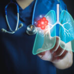 Treatment Combination Improves Survival in EGFR-positive Lung Cancer