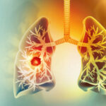 Immunotherapy Approval Marks Progress in Small Cell Lung Cancer
