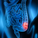 A Common Sign of Colorectal Cancer That Young Adults Might Dismiss