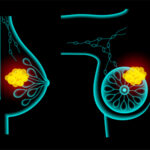 Limiting Surgery in Early-stage Breast Cancer