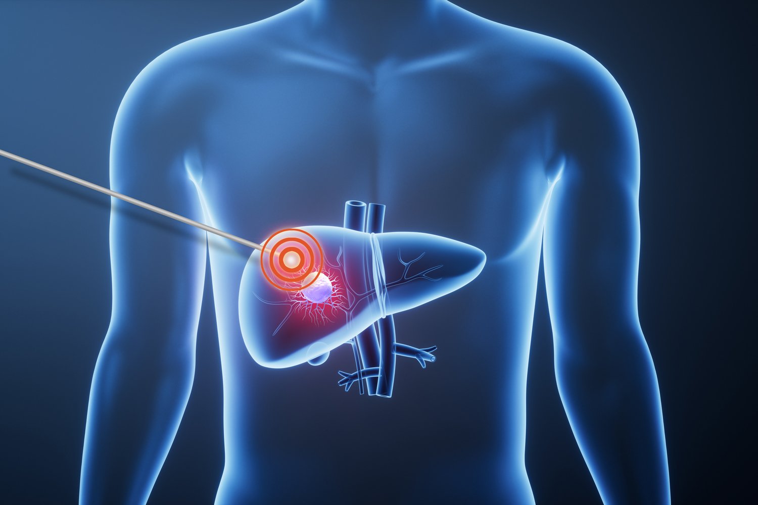 Using Heat to Eliminate Cancer Cells