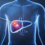 Using Heat to Eliminate Cancer Cells