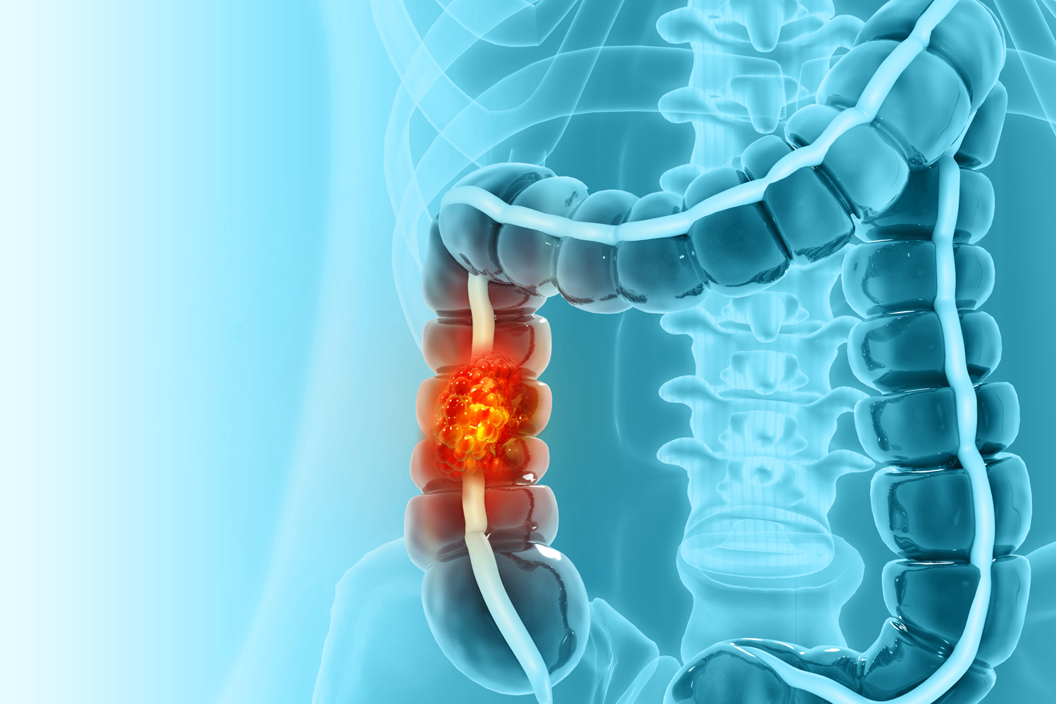 The Week in Cancer News: Immunotherapy for Colon Cancer