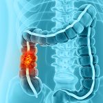 The Week in Cancer News: Immunotherapy for Colon Cancer